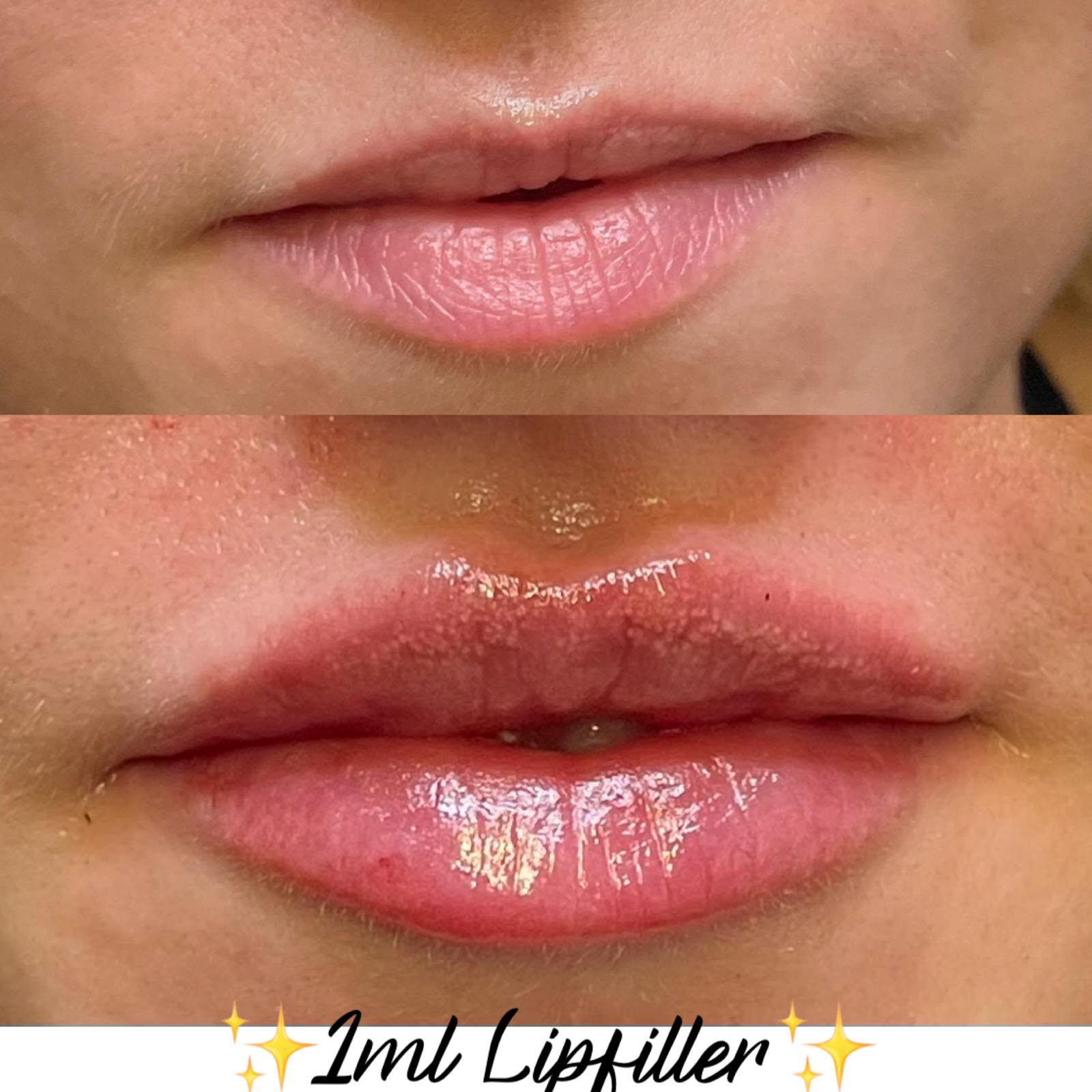 1ml lip filler before and after